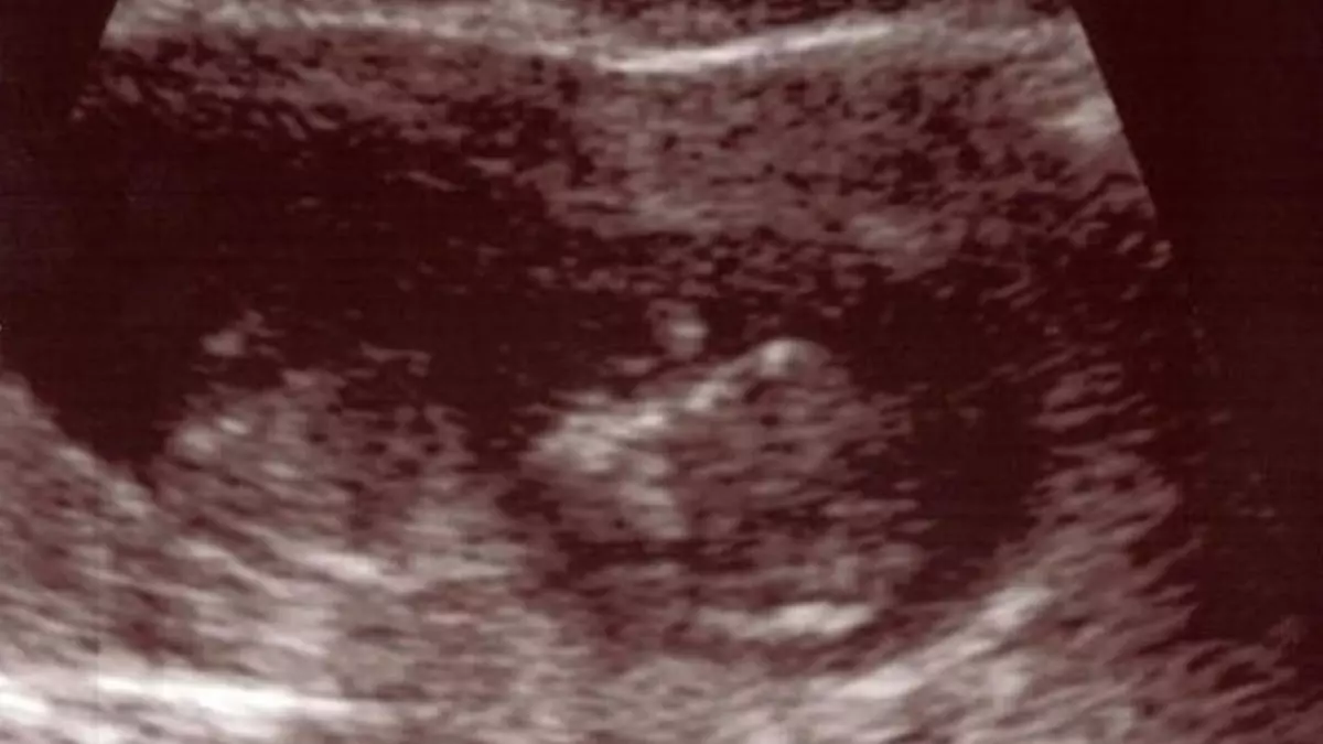 echographie foetus